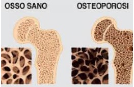 Sabato a Bordighera si parla di Osteoporosi