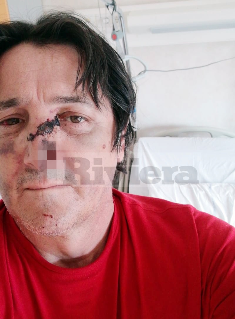 Sbranato al volto da un cane a Sanremo, ora è senza una casa