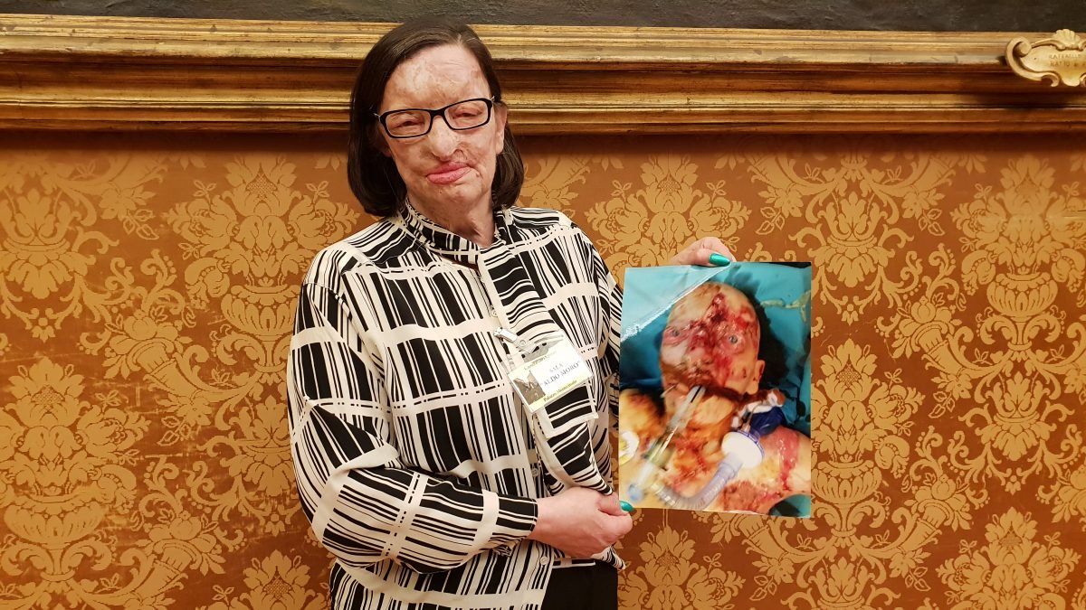 Sfigurata con l’acido dal marito: riceverà un premio