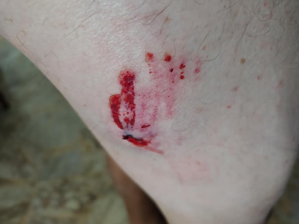 Ciclista azzannato da un cane in bici cerca padrona sui social e la trova