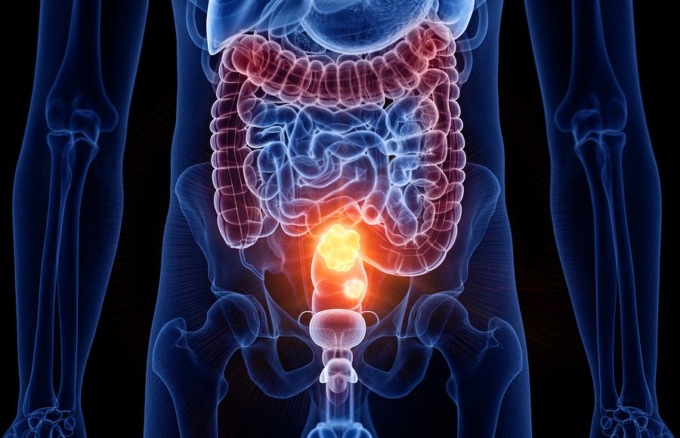 Screening gratuito per la prevenzione del tumore al colon retto