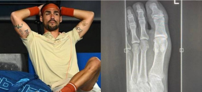 Frattura al piede, ma Fabio Fognini non molla