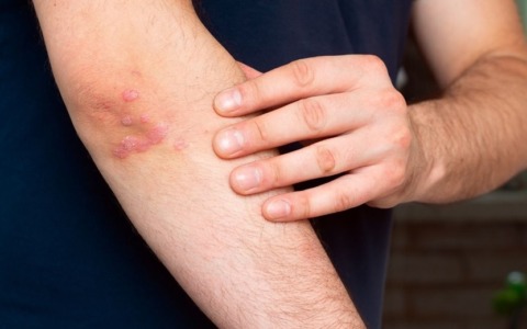 Domani a Palazzo Roverizio si parla di psoriasi