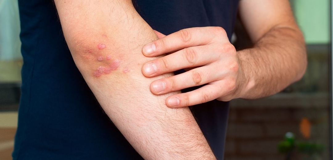 Domani a Palazzo Roverizio si parla di psoriasi